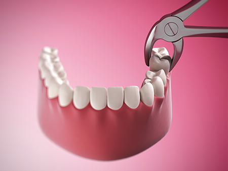 The image shows a close-up of a dental implant being screwed into a pink porcelain tooth with visible bite marks, using a pair of metal pliers.